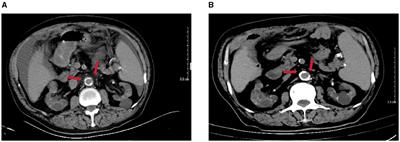 Brucellosis-induced peritonitis and abdominal aortitis in a non-endemic area patient on peritoneal dialysis: a case report and literature review
